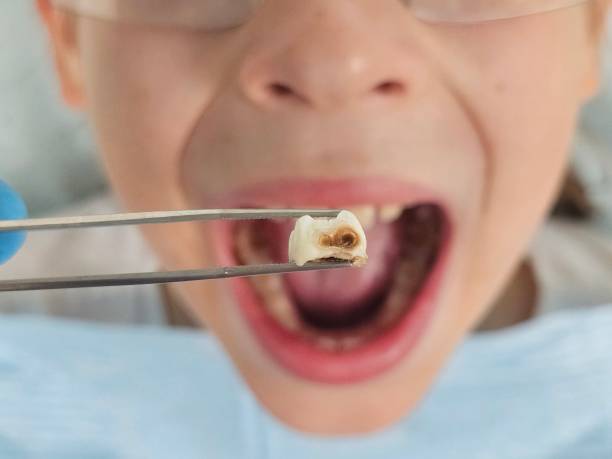 Best Urgent Tooth Repair  in Council Grove, KS